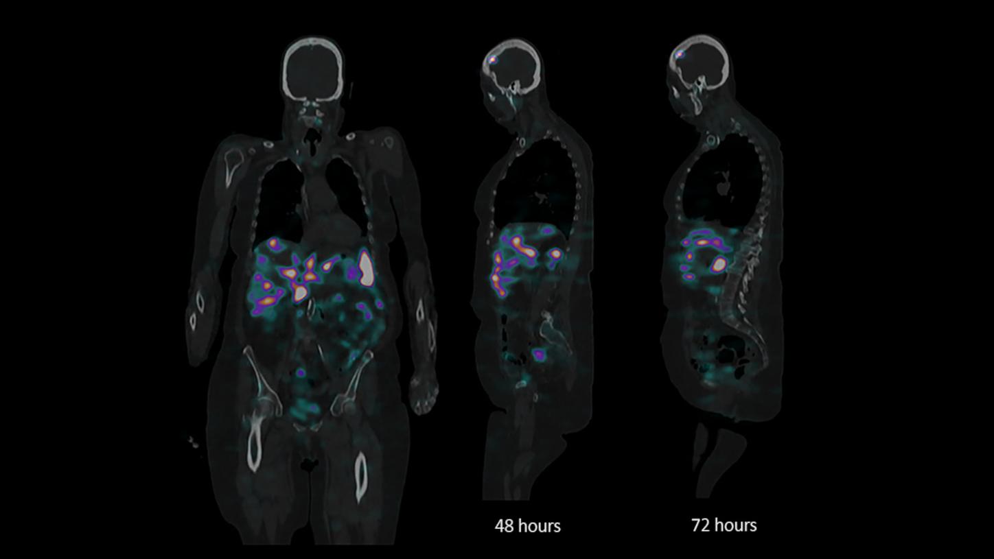 Fast whole-body SPECT/CT w/ xSPECT Quant - therapy response