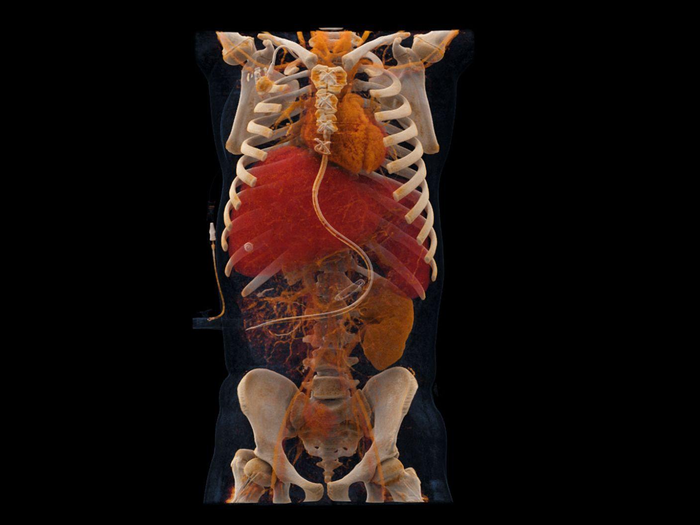 Quantum HD pediatric CT image acquired by a NAEOTOM Alpha photon-counting CT scanner.