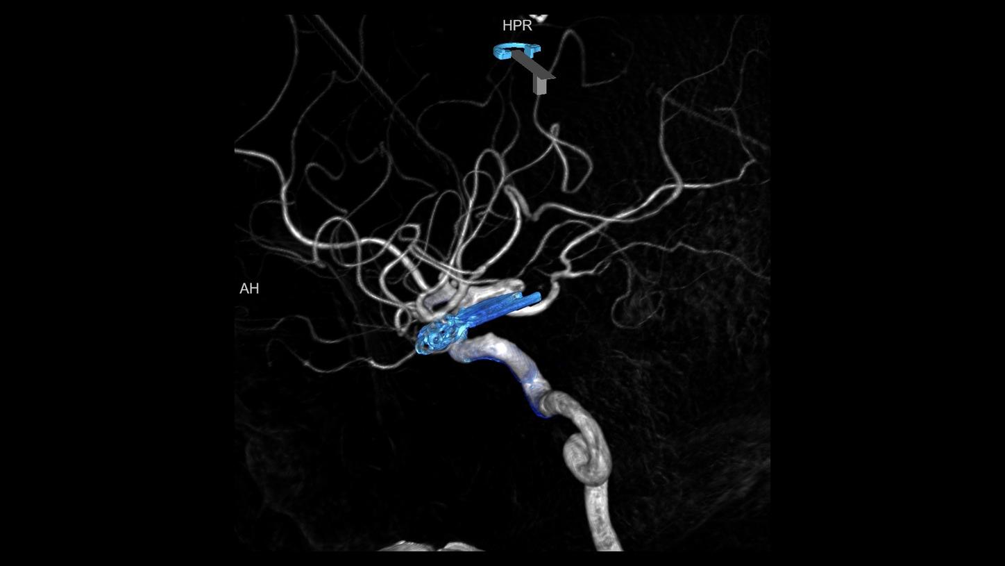 neurology aneurysm clipping