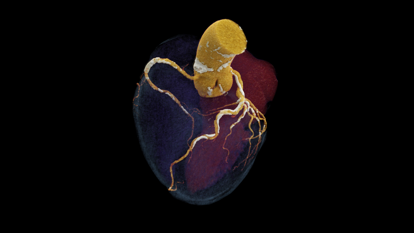 Coronary CTA image of the heart taken with a NAEOTOM Alpha photon-counting CT scanner.