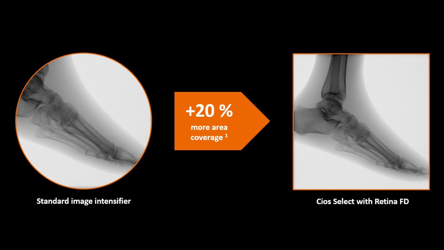 Enhanced 2D image quality with Cios Select, a C-arm for surgery.
