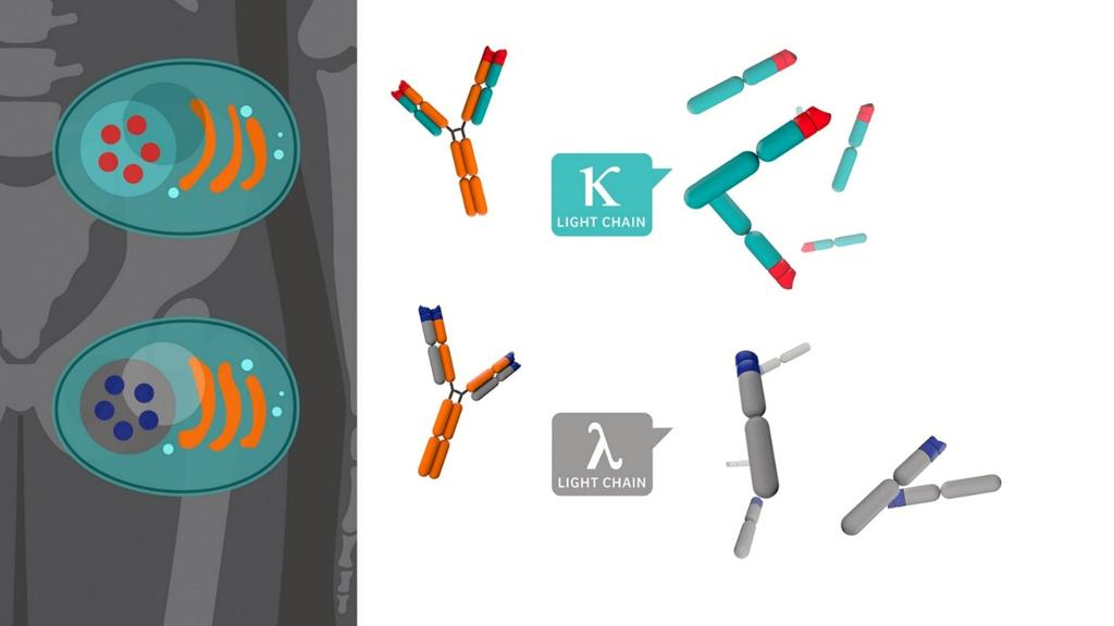 Evaluating MGUS with Free Light Chain Assays in Clinical Practice