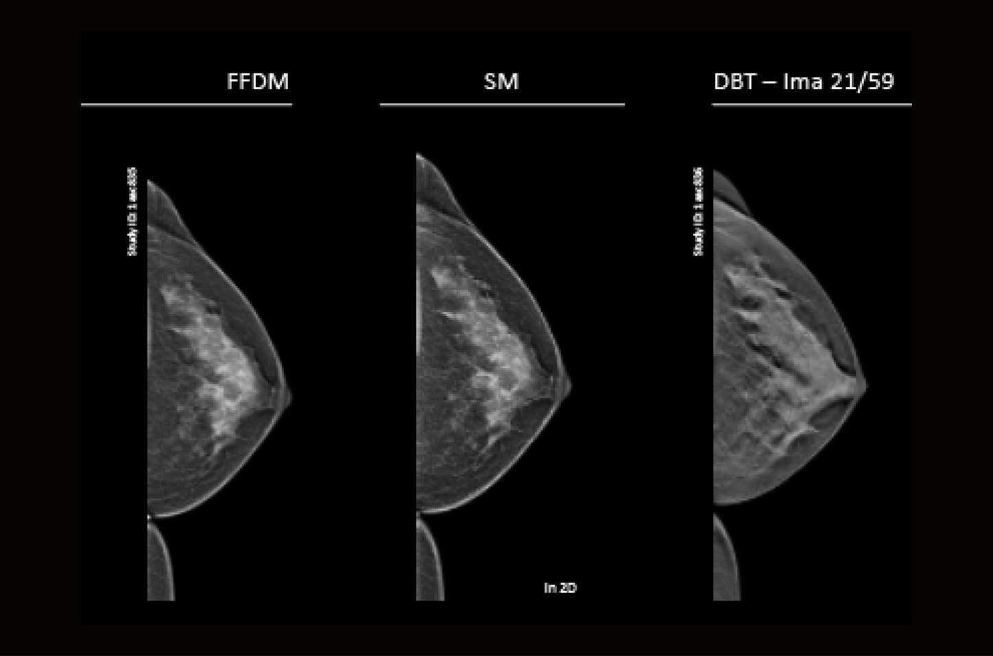 Microcalcificaciones pleomórficas en mama izquierda: diagnóstico de carcinoma ductal in situ grado 2