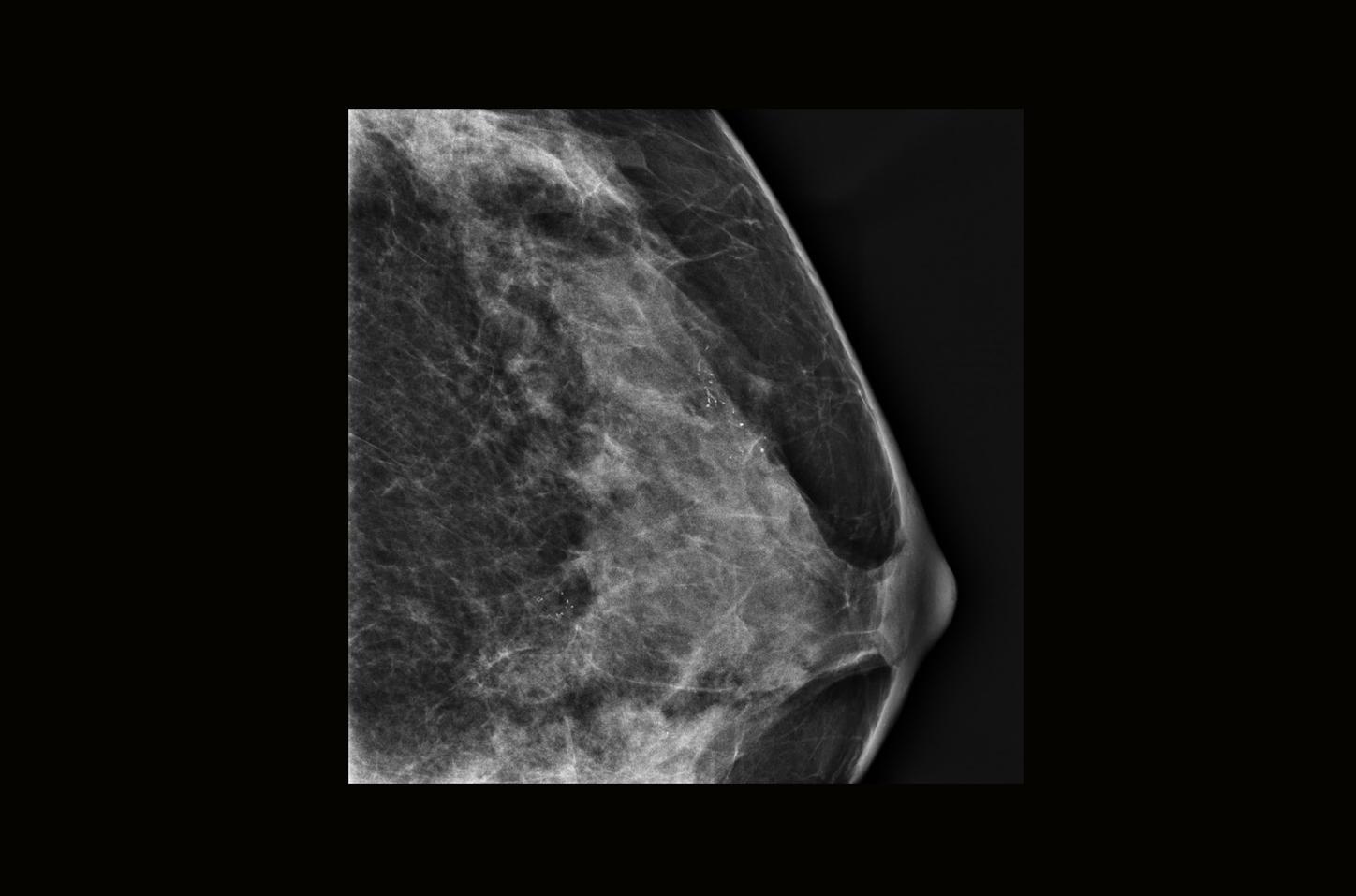 Microcalcificaciones pleomórficas en mama izquierda: diagnóstico de carcinoma ductal in situ grado 2