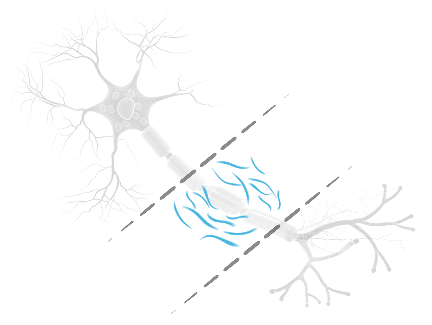 NfL Clinical Brief A first-of-its-kind blood  test aiding patient risk  management in relapsing  multiple sclerosis (RMS)