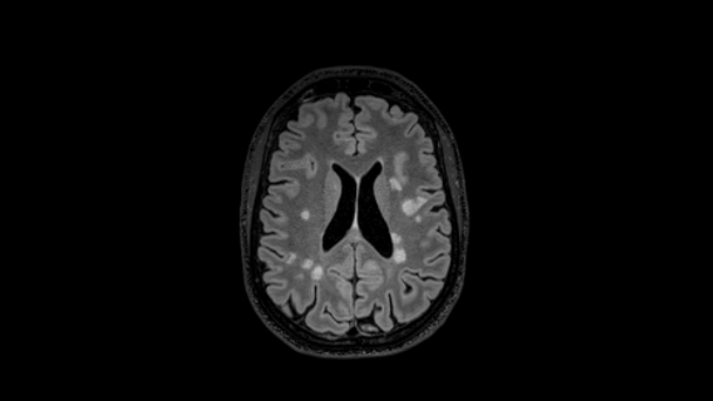 White Matter Hyperintensities (WMH)