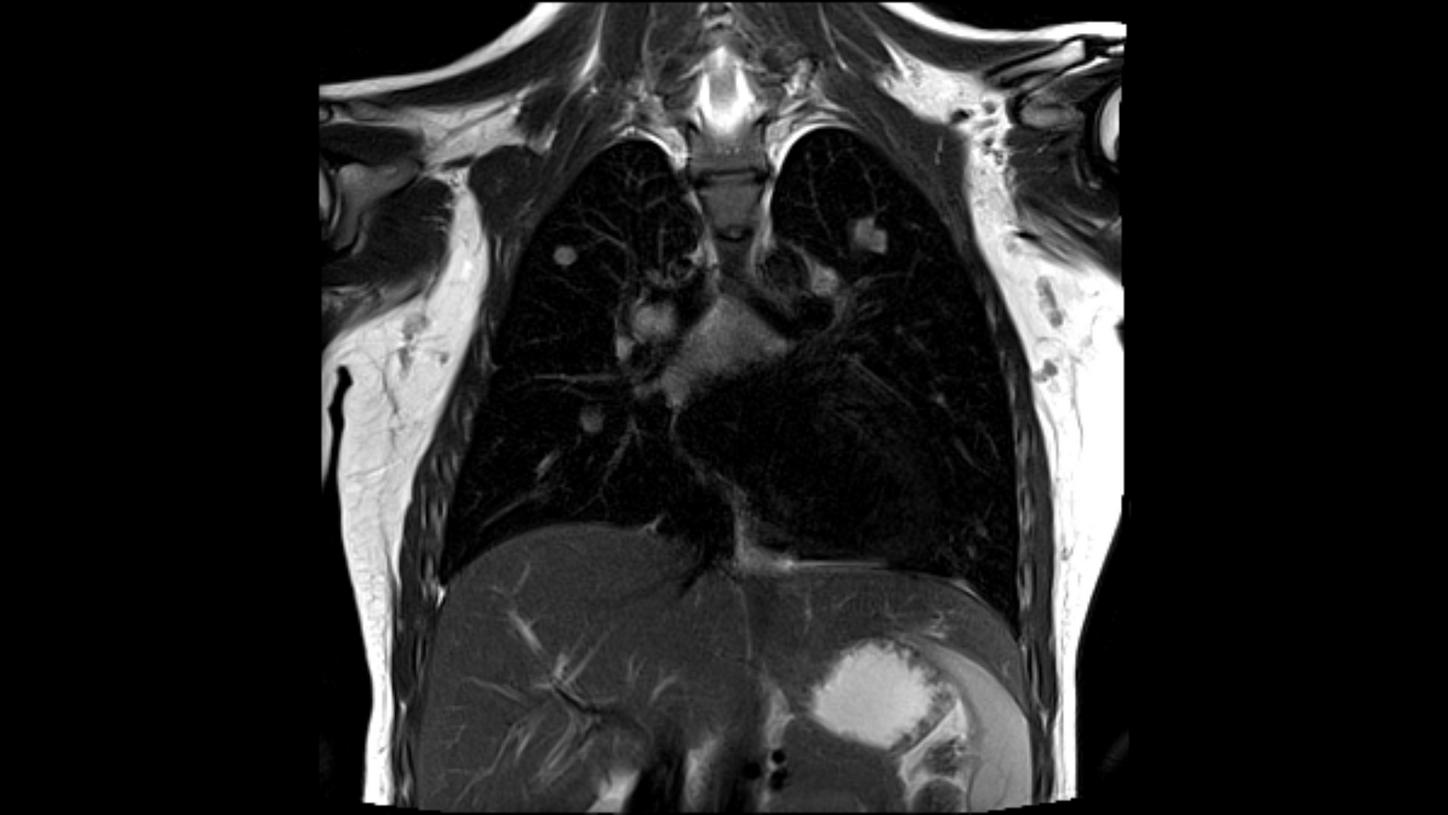 Pulmonary MRI