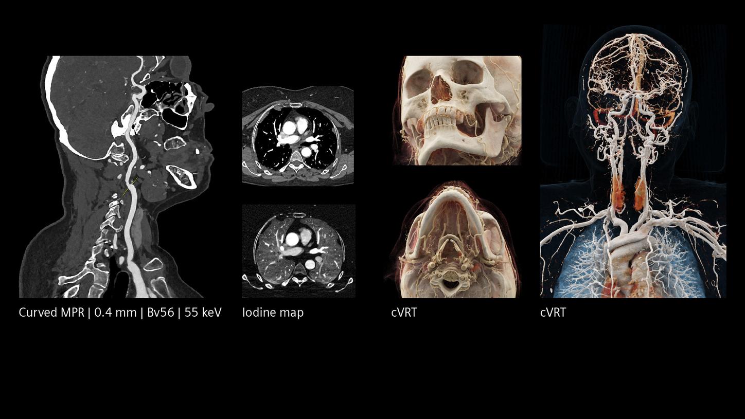CT angiography of head, neck, and chest, curved MPR, and detailed 3D vascular renderings.