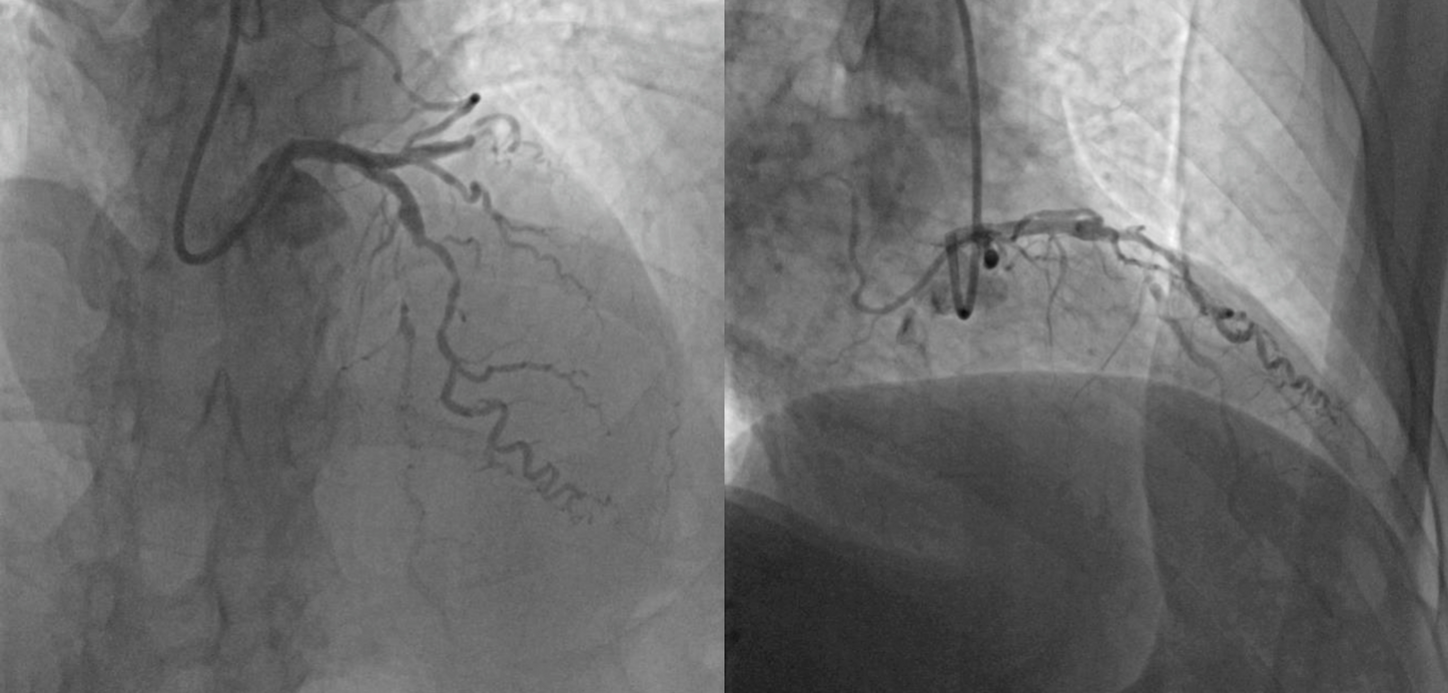 Initial Coronary Angiogram: Anteroposterior (AP) cranial and right anterior oblique (RAO) 44/ cranial 15 views demonstrate a total occlusion of the mid-segment of the left anterior descending (LAD) artery, with retrograde filling from epicardial collaterals.