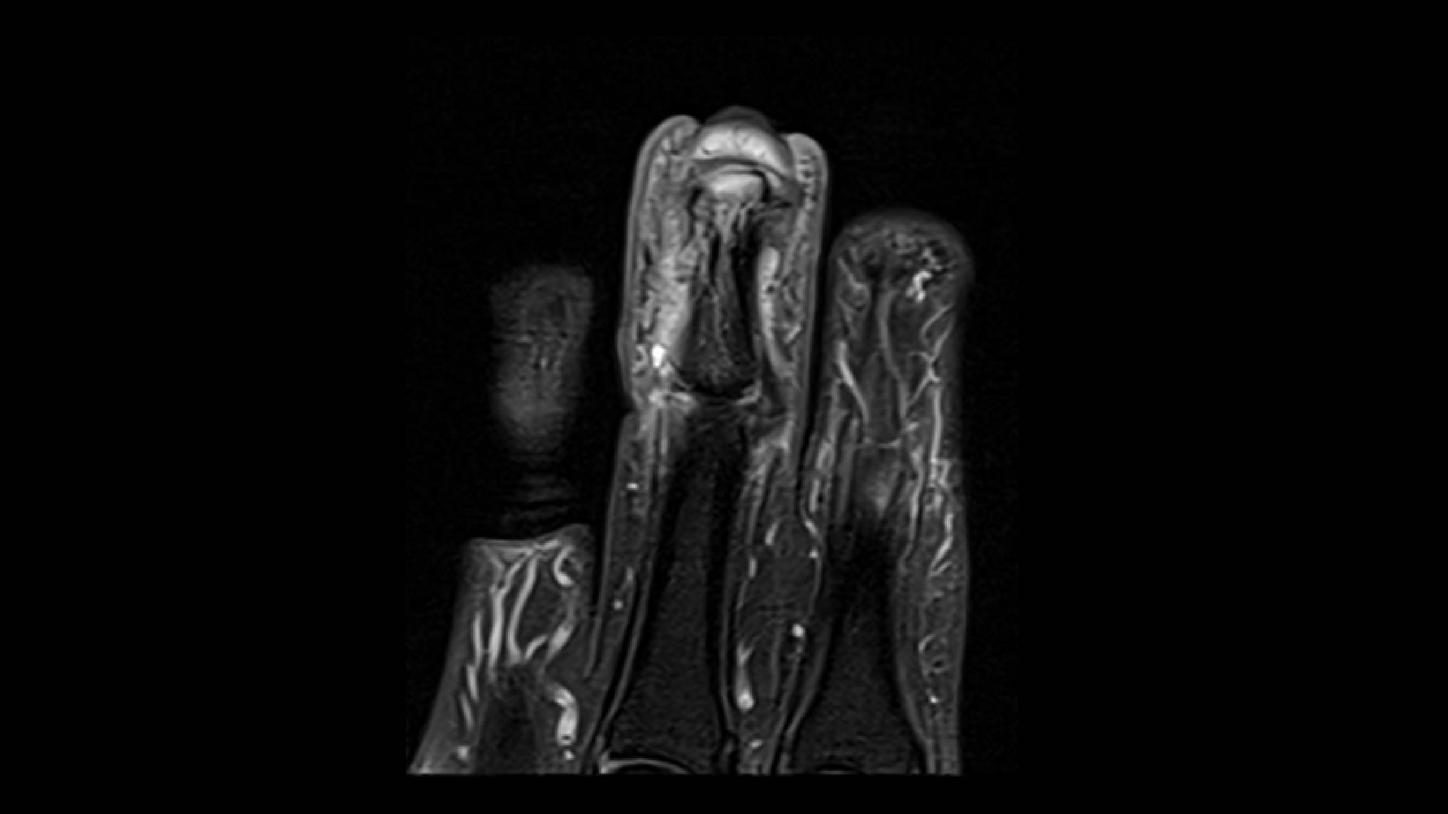 osteomielitis y artritis séptica activa