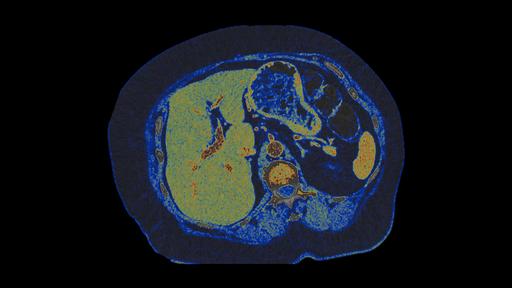 PCCT cardiovascular imaging - Siemens Healthineers