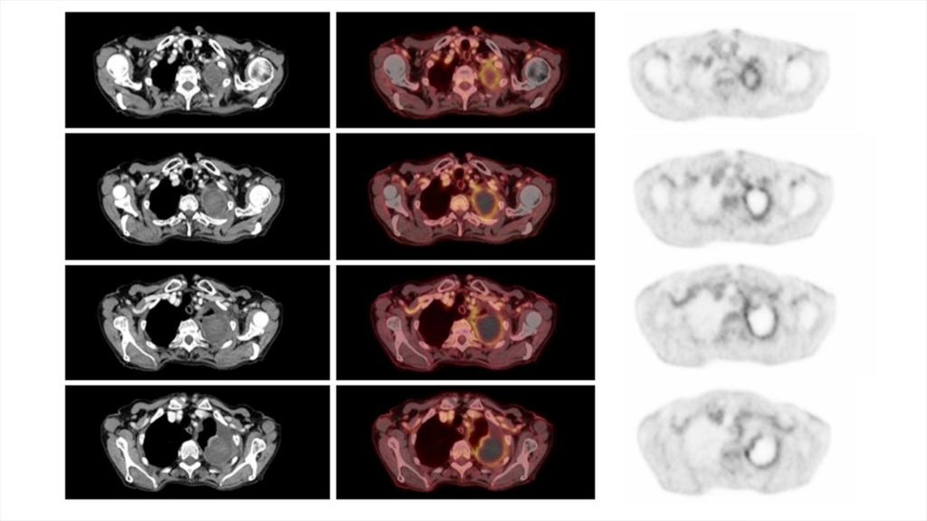 18F-FDG PETCT delineation of predominantly pericardial involvement in ...