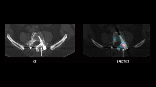 SPECT/CT imaging in the evaluation of pain following spinal fusion ...
