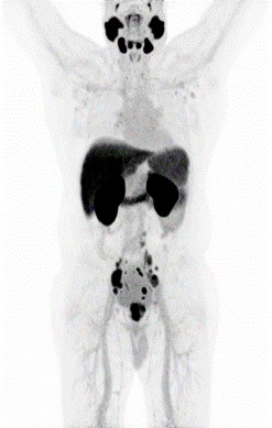POSLUMA Prostate