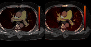 photon ct