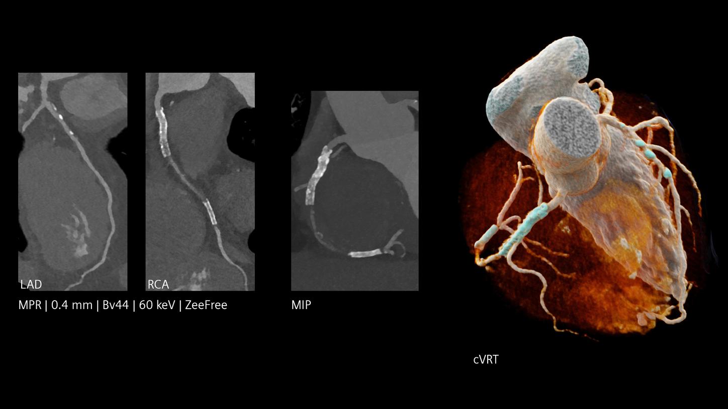 Cardiac CT with multiple coronary stents and a 3D heart model, labeled LAD and RCA, showing scan parameters.