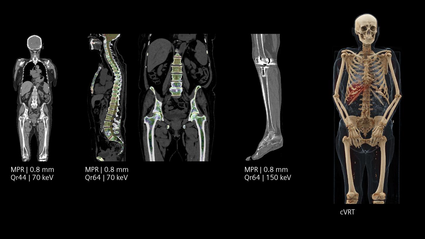 Whole body bone marrow imaging