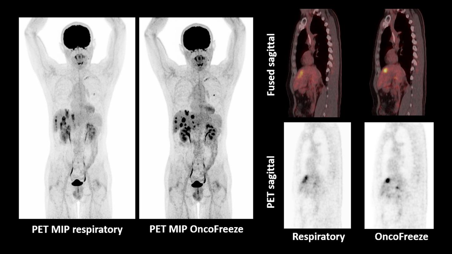 OncoFreeze improves visualization of liver metastases with respiratory motion management