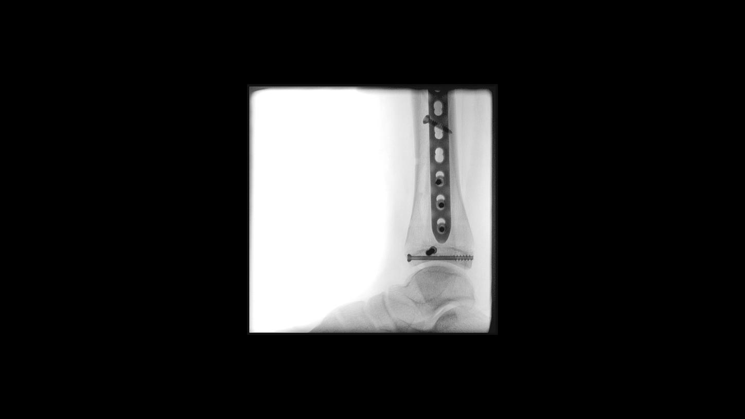 Tibia-fibula distal surgery with Cios Select, a 2D C-arm for surgery.