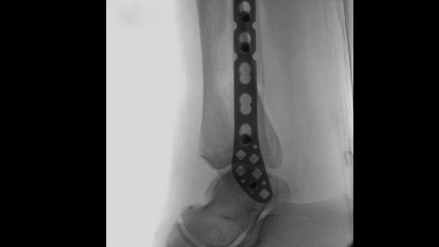 Distal tibia surgery with Cios Fit, a mobile 2D C-arm for surgery.