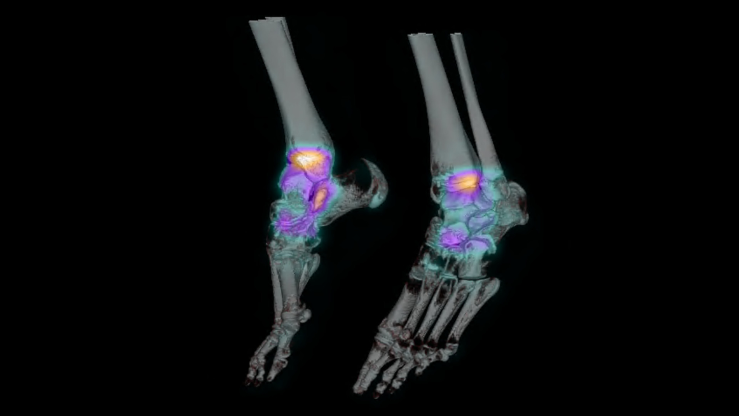 Symbia Pro.specta SPECT/CT scan