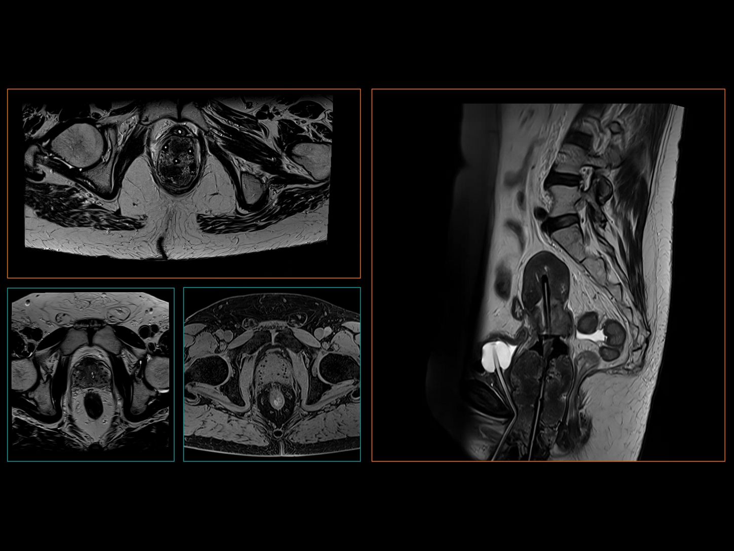 Siemens-healthineers_Magnetomworld_Protocol_Brachy