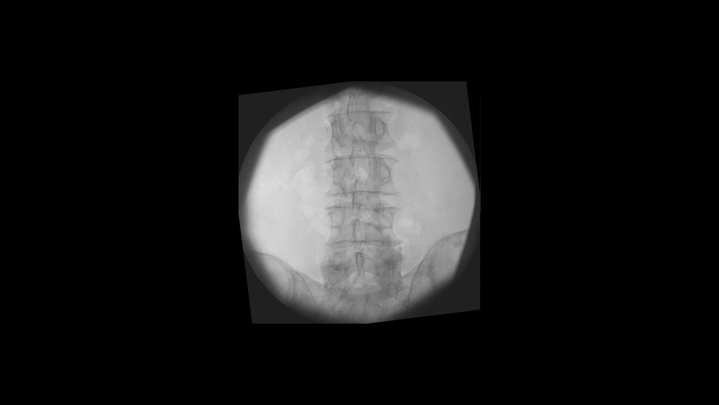 Lumbar spine surgery with Cios Select, a 2D C-arm for surgery.