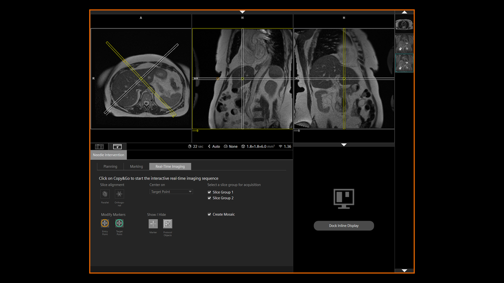Interventional MRI Suite – Leading the way in iMRI - Siemens Healthineers