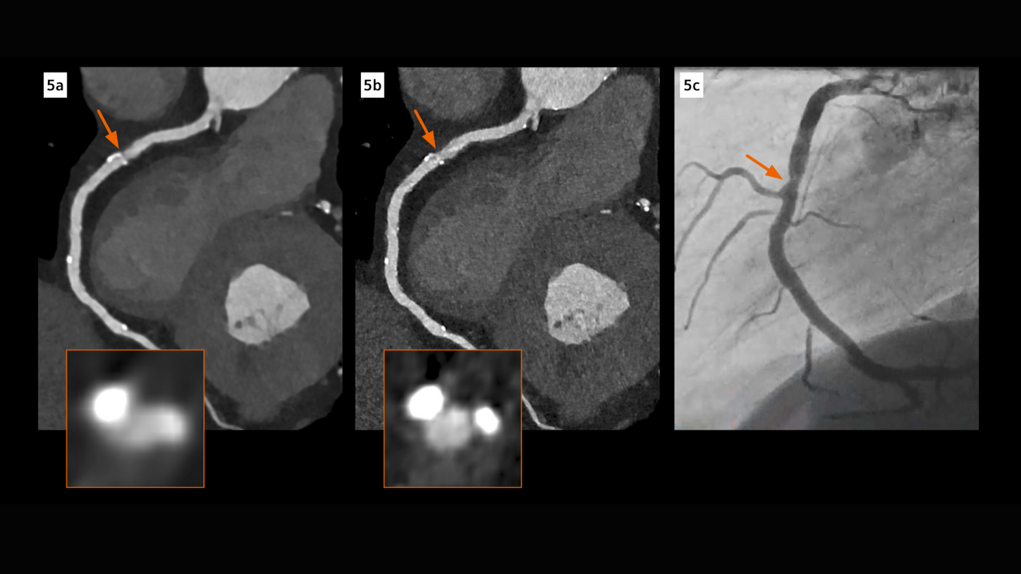Photon-counting technology for cardiac CT