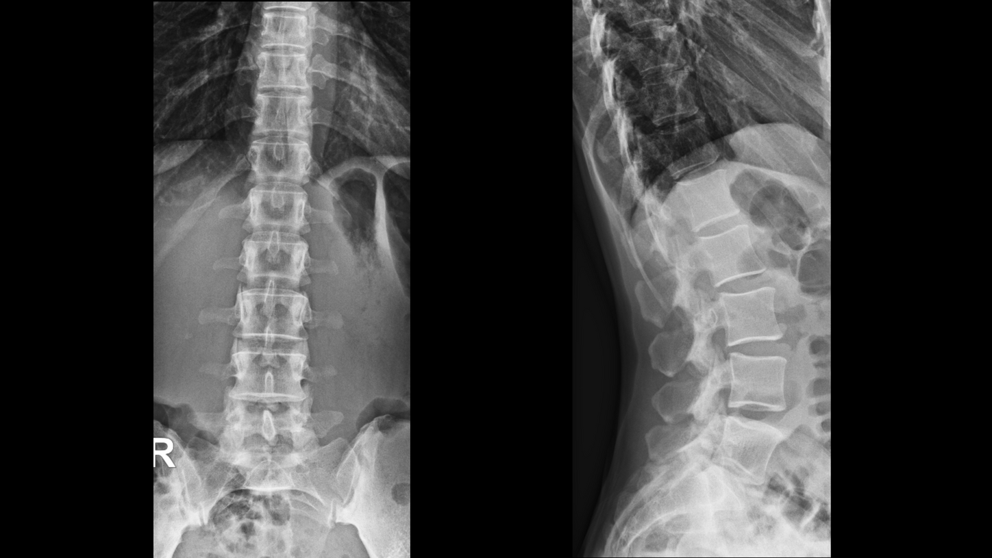 DI XP Luminos Qnamix L-Spine