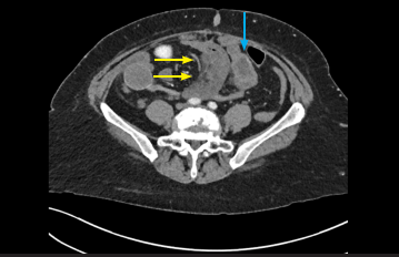 Fig. 7: Yellow arrow showed focal segment of small bowel devoted from iodine /contrast uptake, blue arrow showed normal mucosal enhancement.