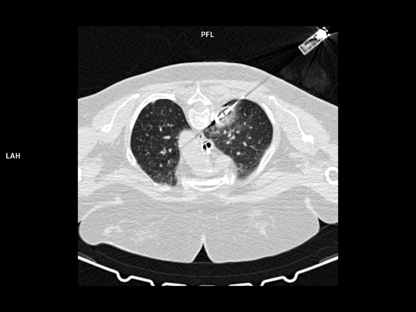 CT image-guided lung biopsy using SOMATOM go.Up and myNeedle Guide; Axial view; i-Sequence