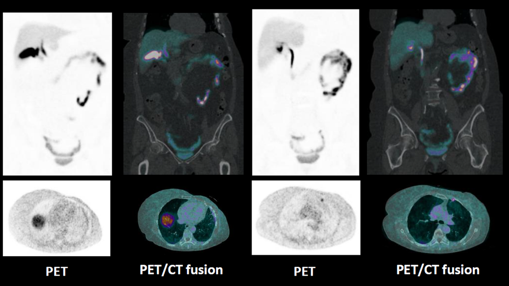 Biograph Vision PET/CT Scanner - Siemens Healthineers India