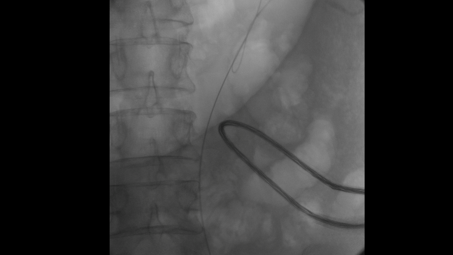Urology guidewire with Cios Fit, a mobile 2D C-arm for surgery.