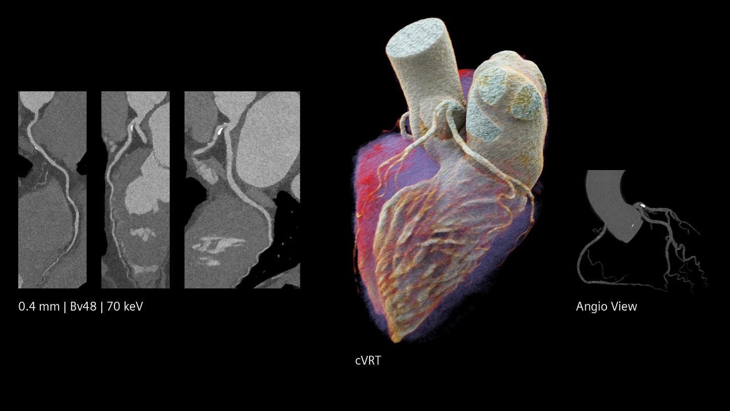 Clinical images: 0.4mm, cVRT, and Angio-Ansicht visualizing extraordinary detail of coronary vessels with full dose efficiency.