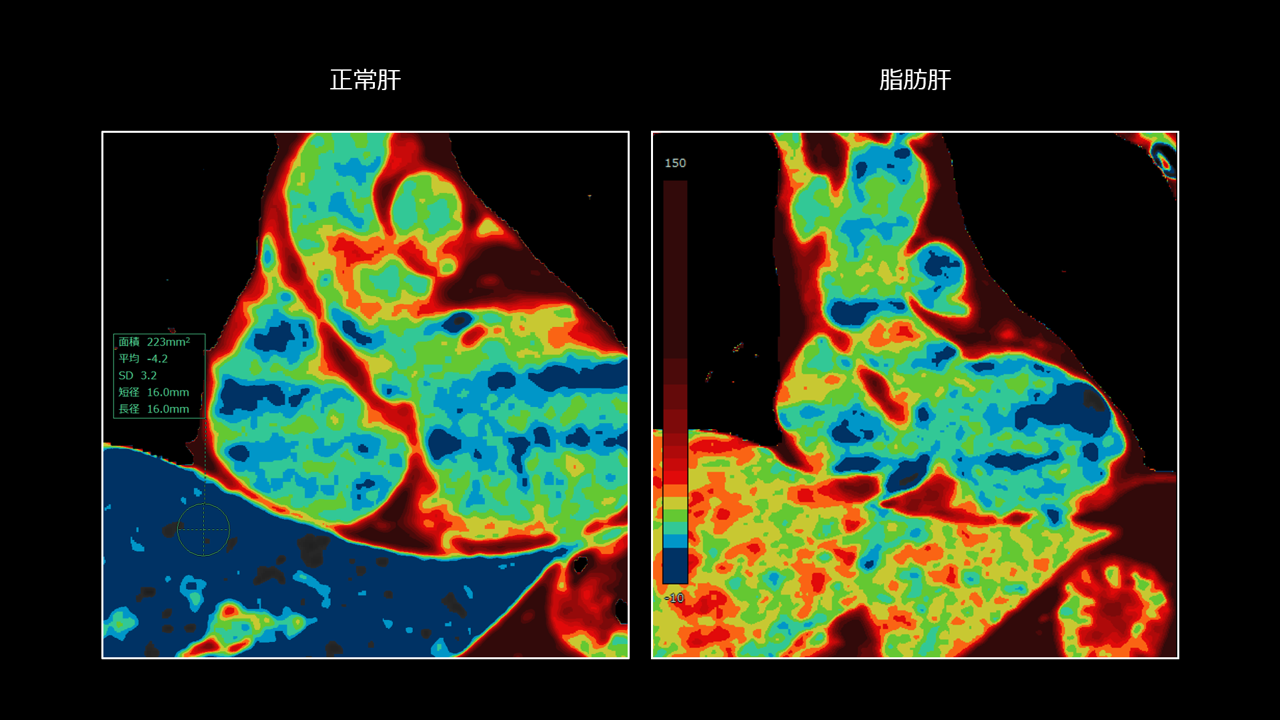 DE Fat MapによるMASLD(代謝異常関連脂肪性肝疾患)の評価