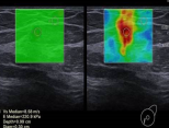 Image D: Elastography images also suggest a hard mass.