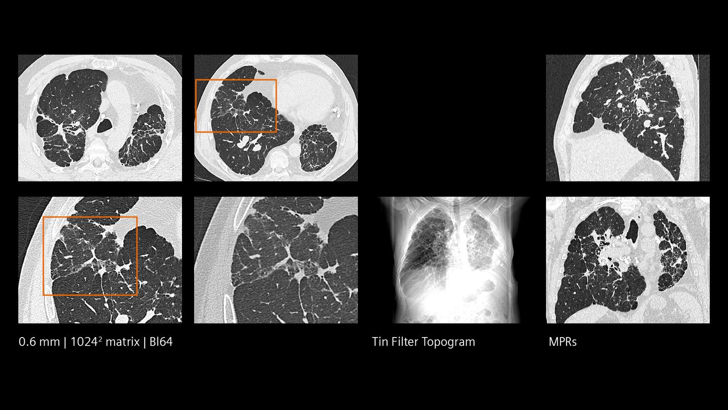 Clinical images of severe interstitial lung disease.
