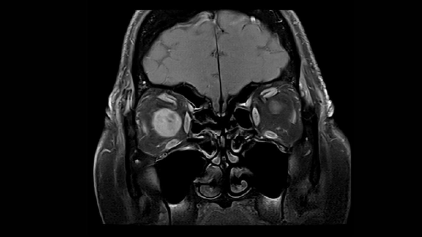 meningioma óptico