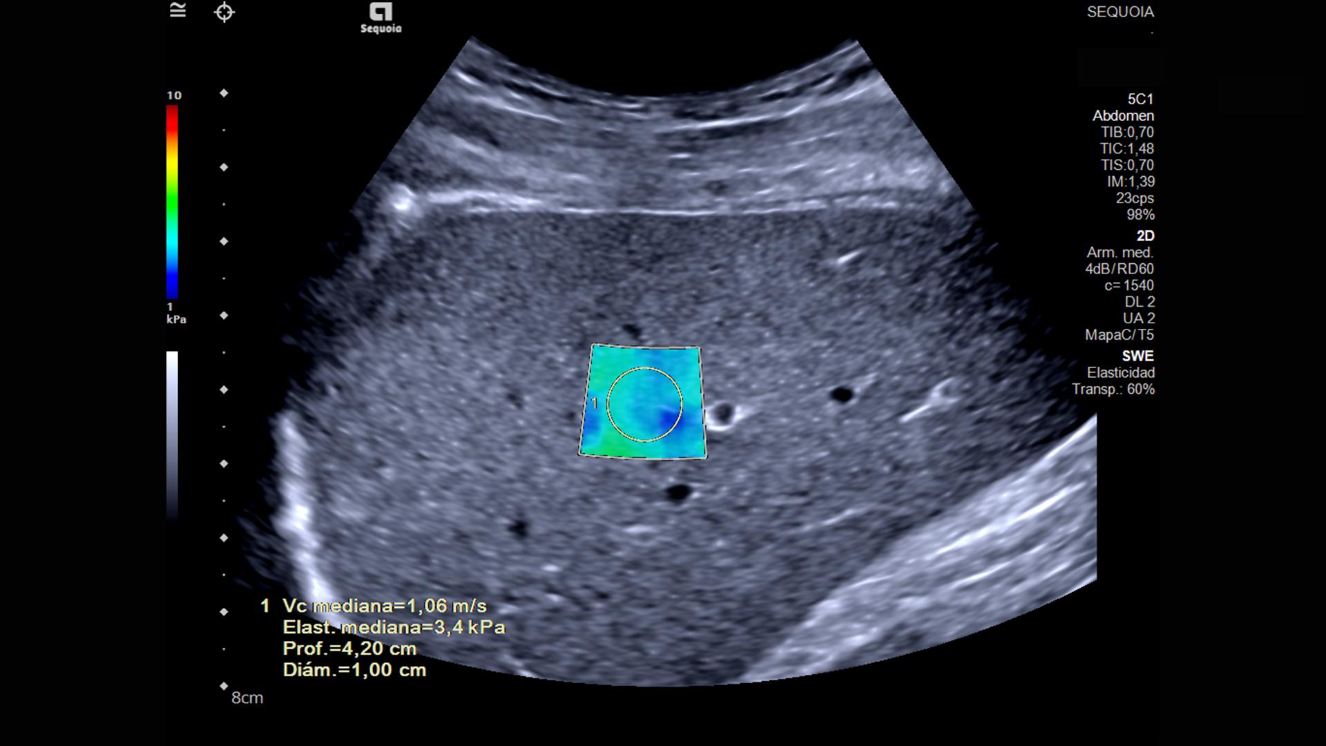 Elastografía - Siemens Healthineers Latinoamérica