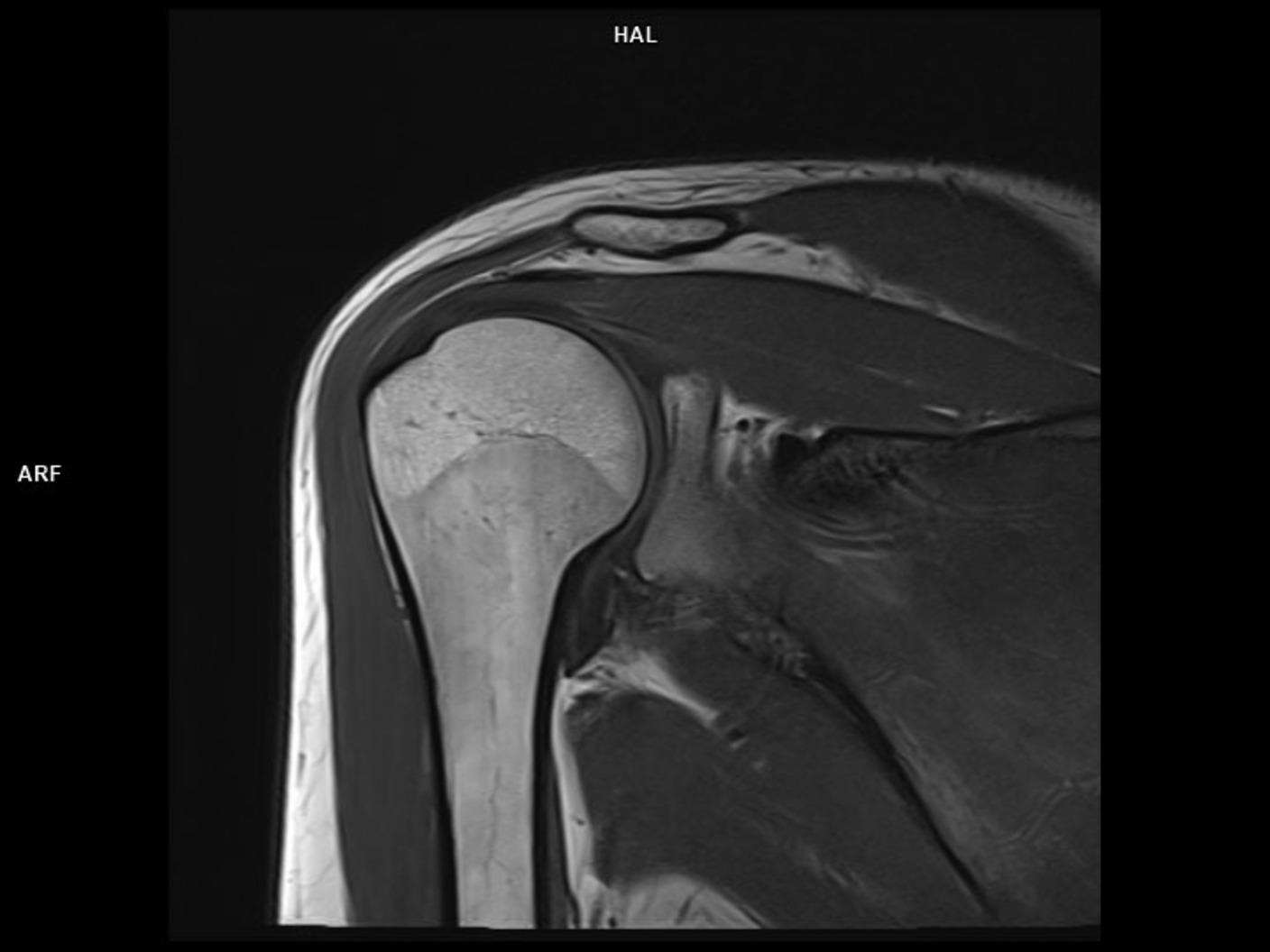 Coronal T1 TSE-MAGNETOM Lumina<br />