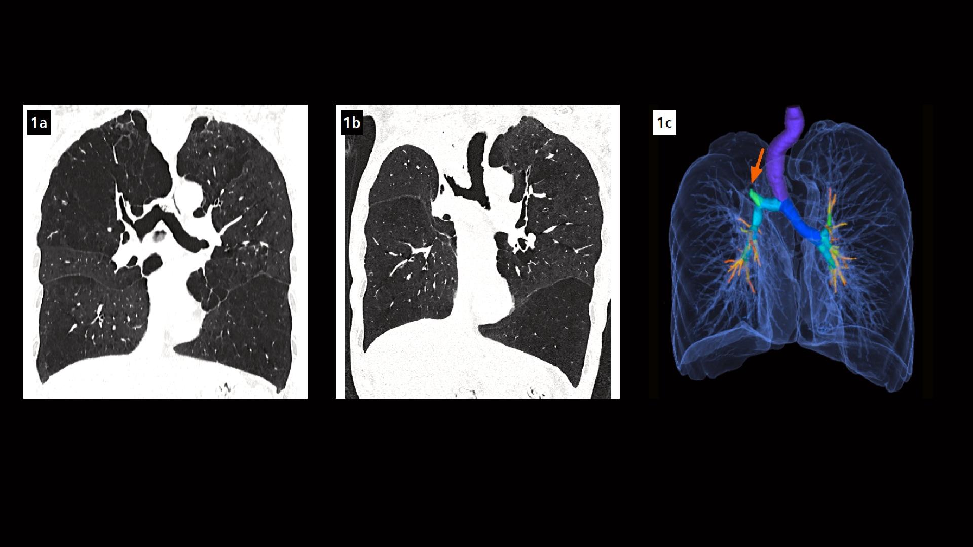 Severe emphysema treated with endobronchial valves Siemens Healthineers
