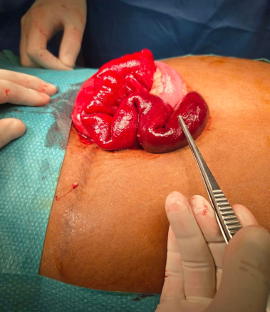 nasogastric tube and Foley catheter