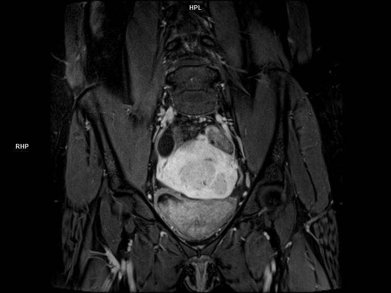 Coronal StarVIBE-MAGNETOM Lumina/Coil-Body 12/Spine 24/Resolution-320/Scan Time-4:27