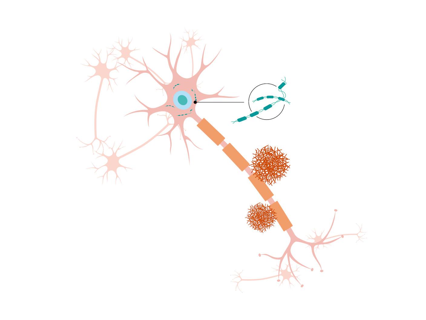 Illustration of neuron with tau buildup