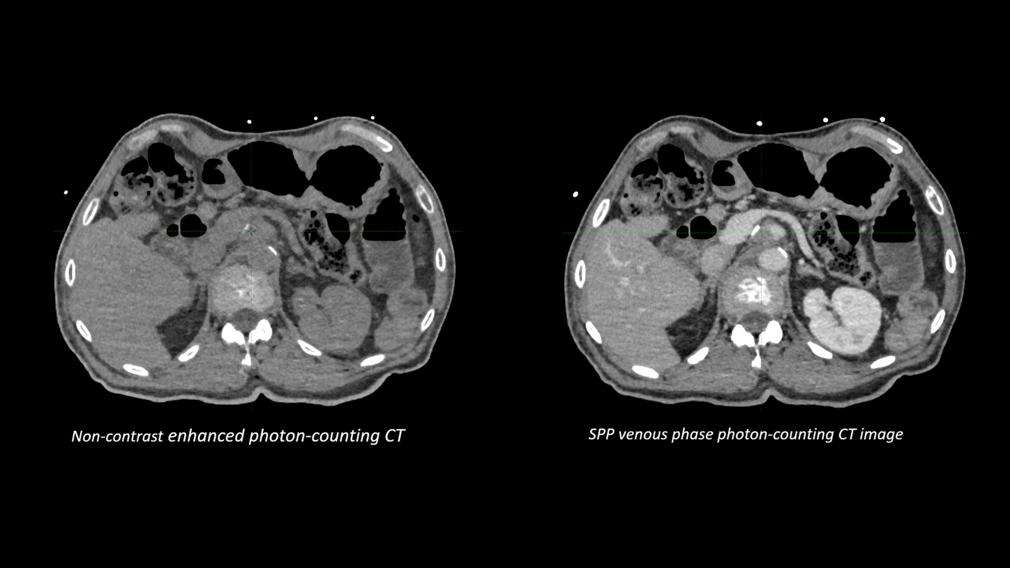 Side-by-side CT images of the abdomen: left shows a non-contrast enhanced photon-counting CT, right shows an SPP venous phase photon-counting CT.