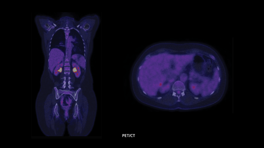 Biograph Vision clinical case