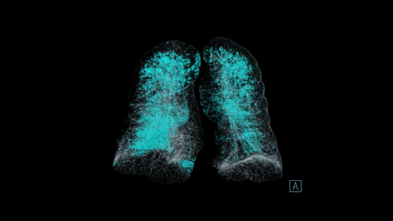 Smart AI tools - detect and highlight lung nodules