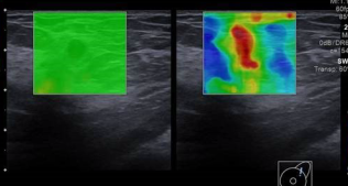 Image C: Elastography image shows heterogeneous red elasticity, with higher velocities in the mass compared to the surrounding breast tissue, indicating marked stiffness of the mass.