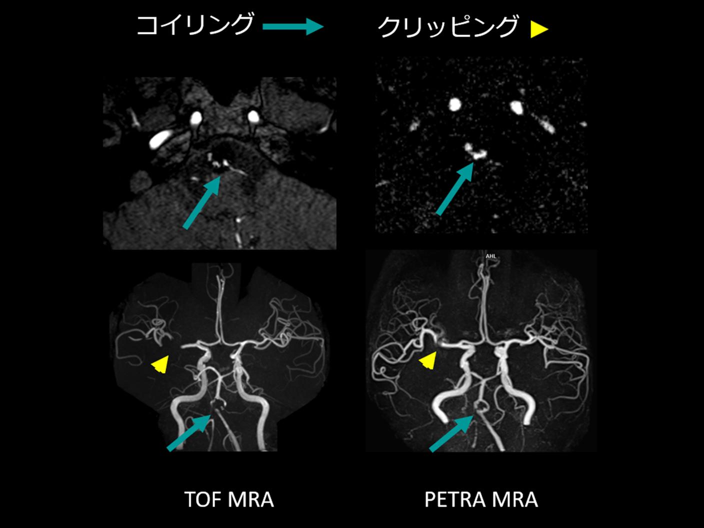 PR MAGNETOM Vida and Lumina Pro Edition Stroke Clinical Image